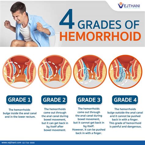 Can You Get Hemorrhoids From Doing Anal