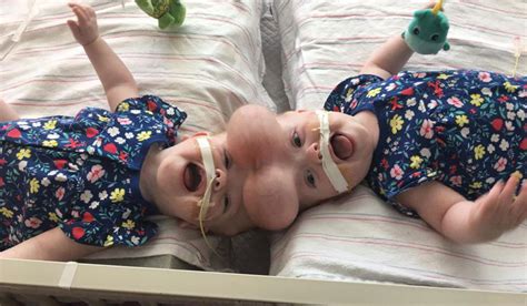 Separation Of Siamese Twins