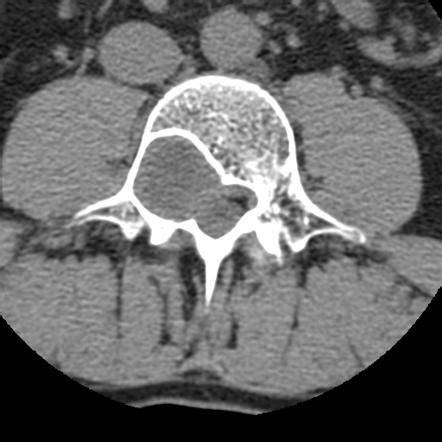 Spinal Schwannoma Radiology Reference Article Radiopaedia Org Spinal Schwannoma Radiology Reference Article Radiopaedia Org