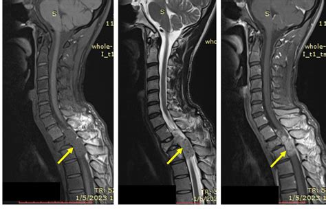 Spinal Schwannoma Spinal Schwannoma