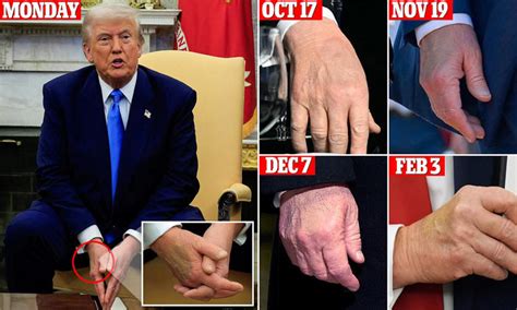 Trump Undergoes Medical Exam For Swelling In Legs Hand Bruising Trump Undergoes Medical Exam For Swelling In Legs Hand Bruising