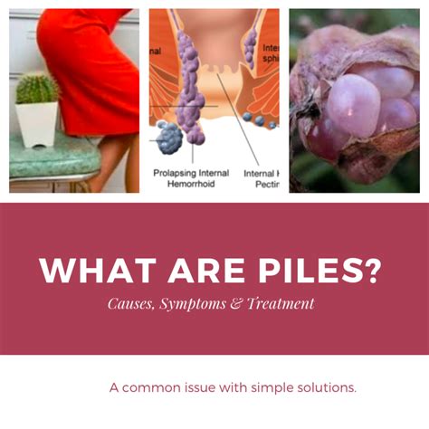 What Do Piles Look Like Nhs At Esther Parr Blog